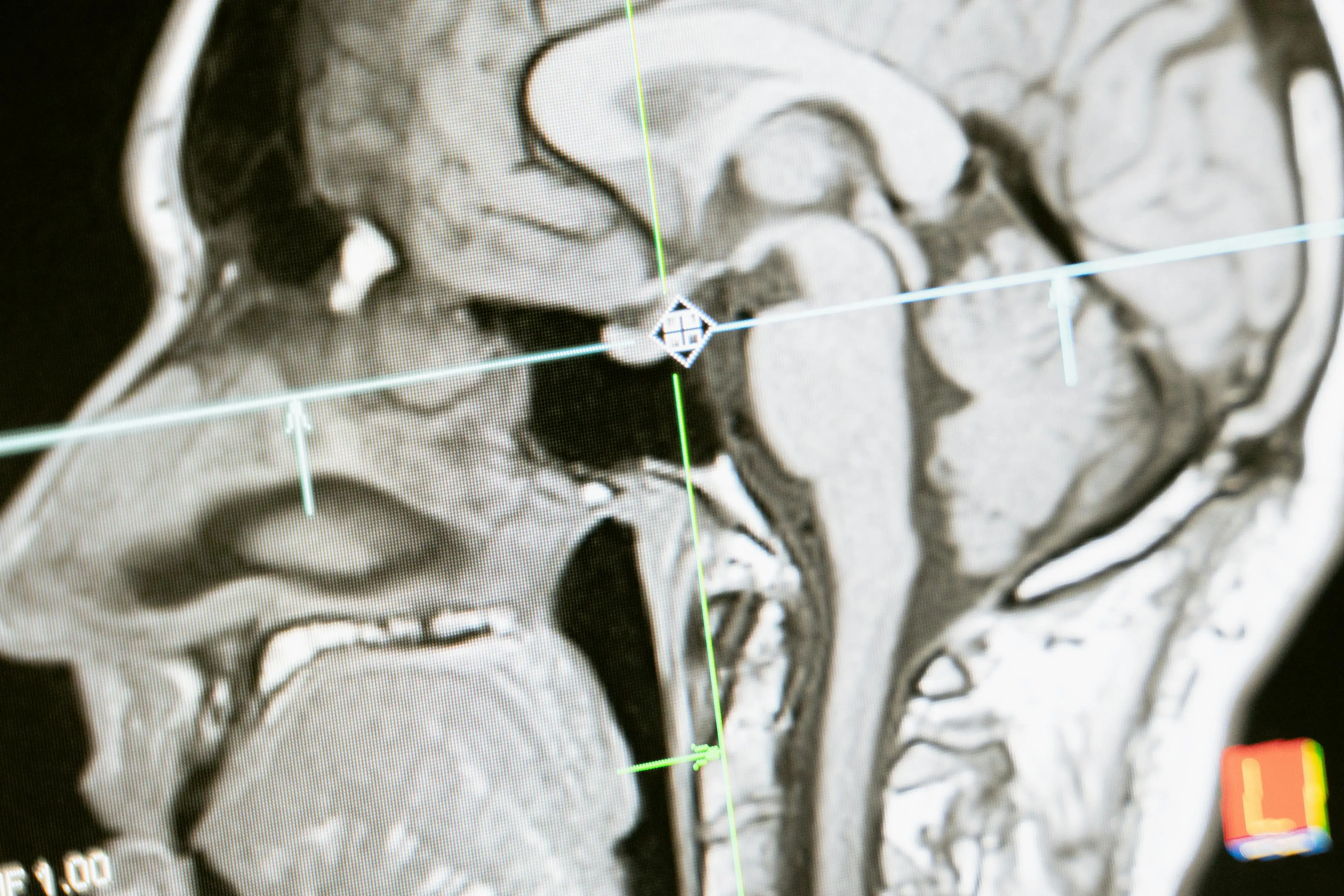 neuro scan.