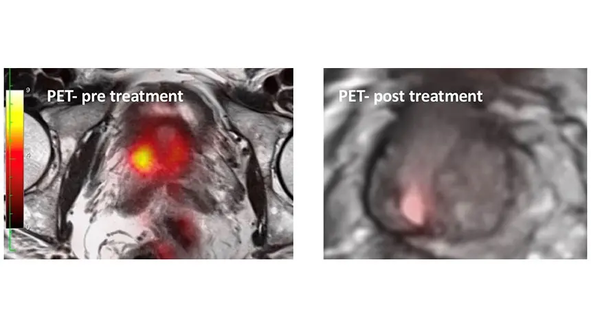 PET pre and post treatment