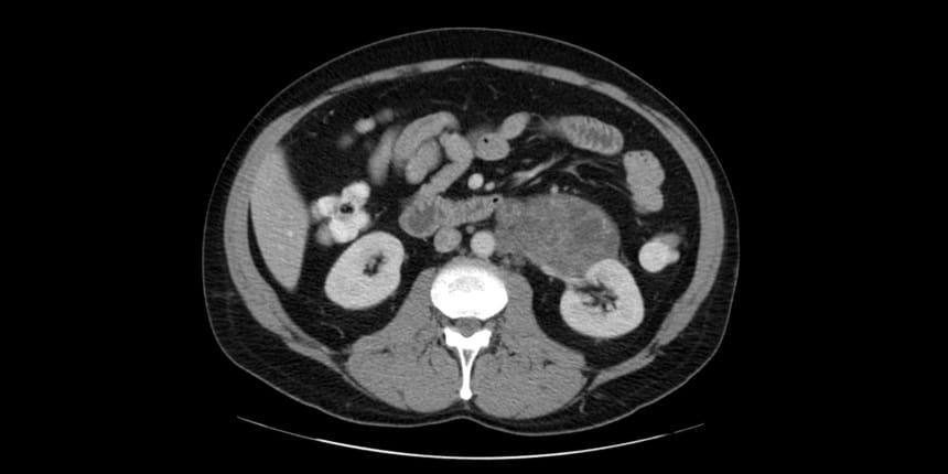Testicular Cancer Clinical Care