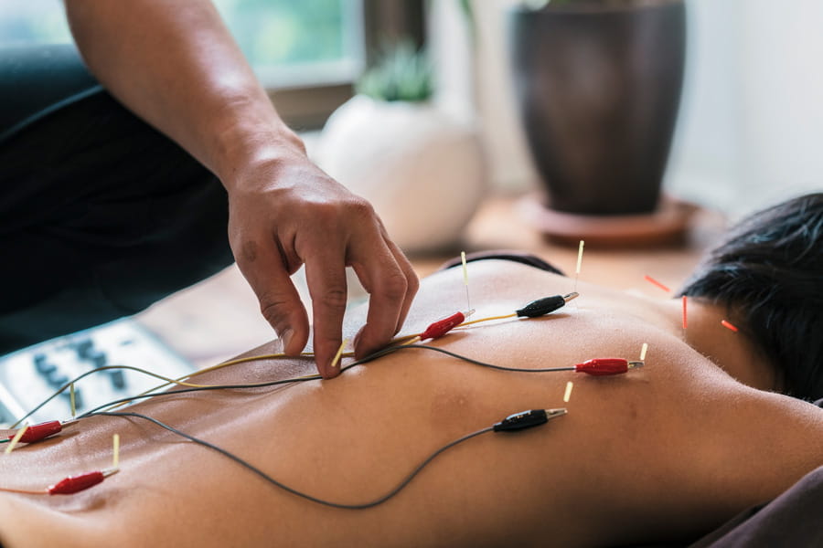 a person's back with acupuncture needles