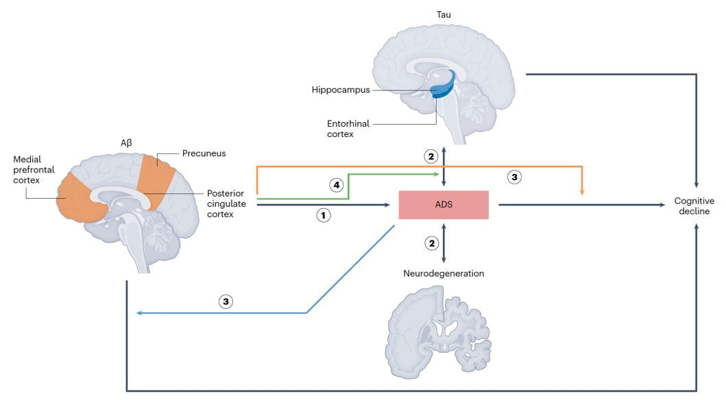 anxious-depressive symptom-facilitated alzheimer's disease progression model