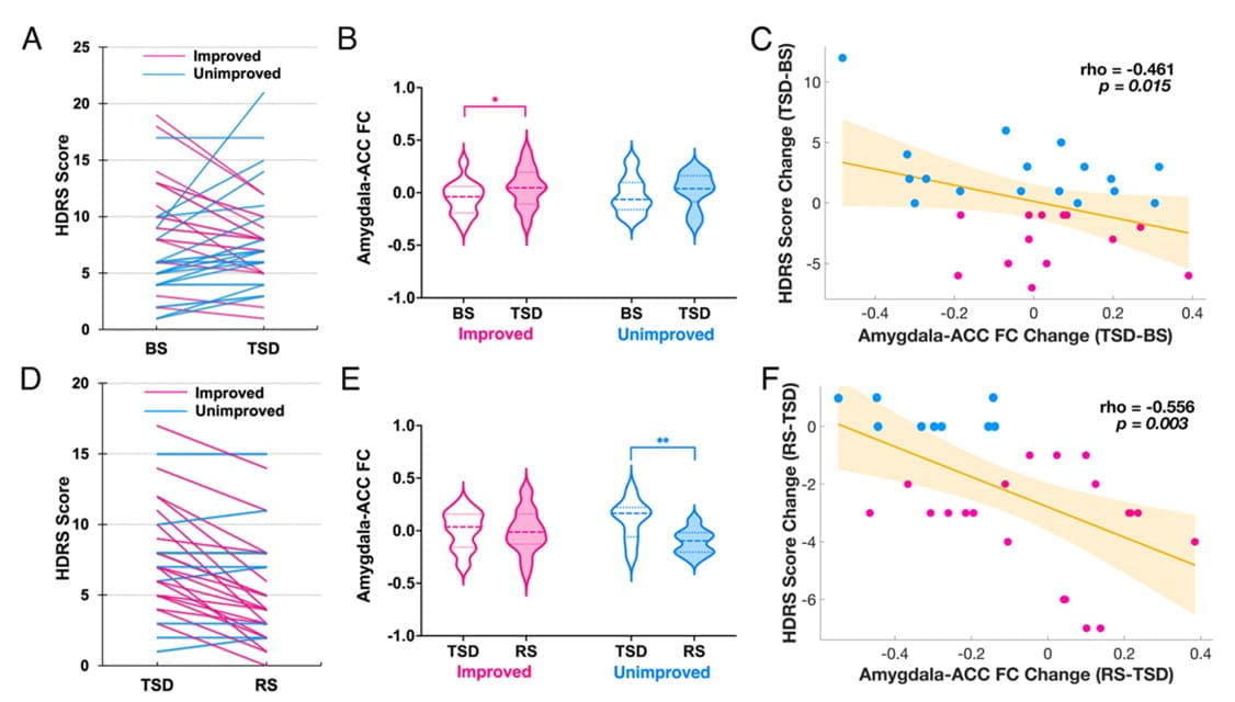 model showing changes in depressive mood, amygdala–ACC connectivity and their association with sleep deprivation in depressed individuals