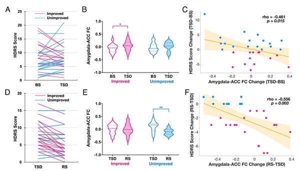 model showing changes in depressive mood, amygdala–ACC connectivity and their association with sleep deprivation in depressed individuals