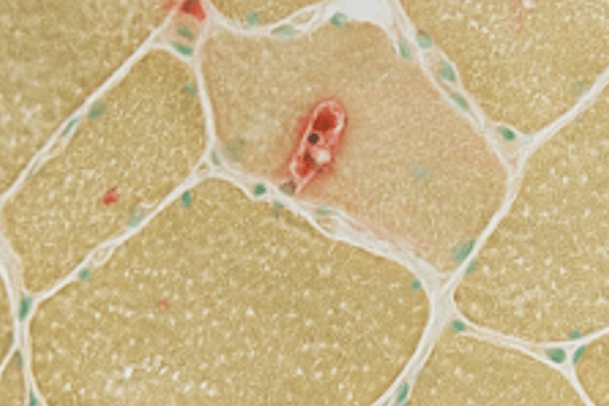 neuromuscular disease imaging