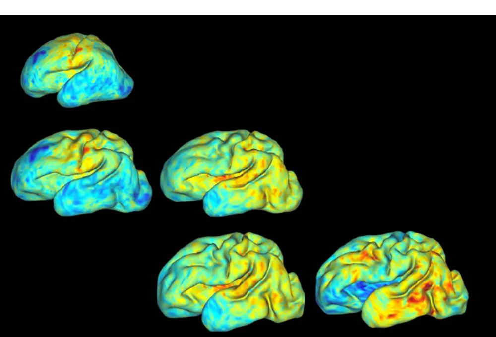 multicolor imaging scans of folding patterns in the brains of premature babies. 