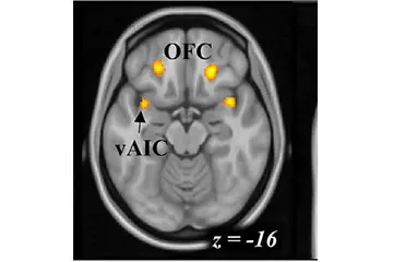 image of a brain scan