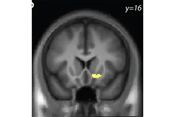 image of a brain scan