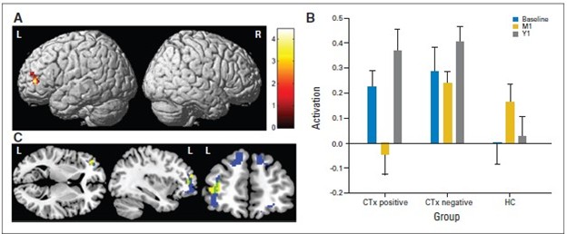 brain scans and a bar graph shows changes in brain activation over time
