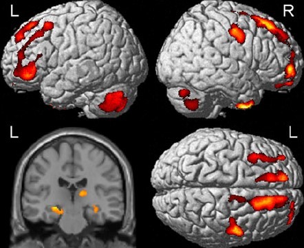 MRI imaging shows active areas of the brain highlighted in red and yellow