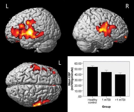 TBI brain imaging shows active areas in the brain highlighted in red and yellow