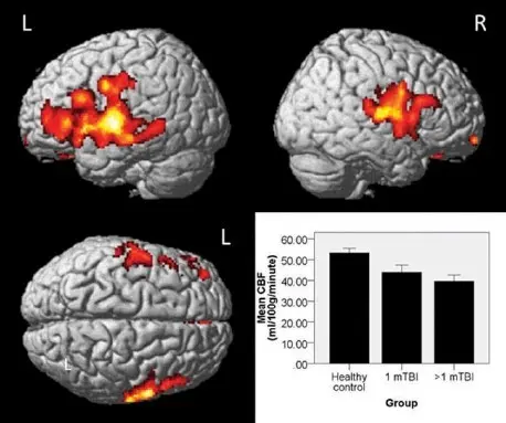 TBI brain imaging shows active areas in the brain highlighted in red and yellow