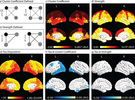 Images of brain scans for Alzheimer's.