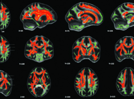Images of brain scans for concussion.