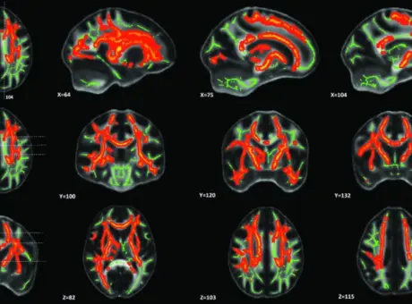 Images of brain scans for concussion.