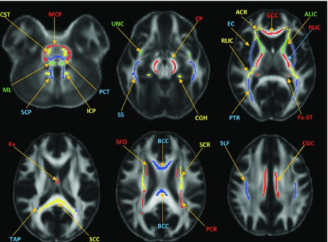 Images of brain scans for TBI.