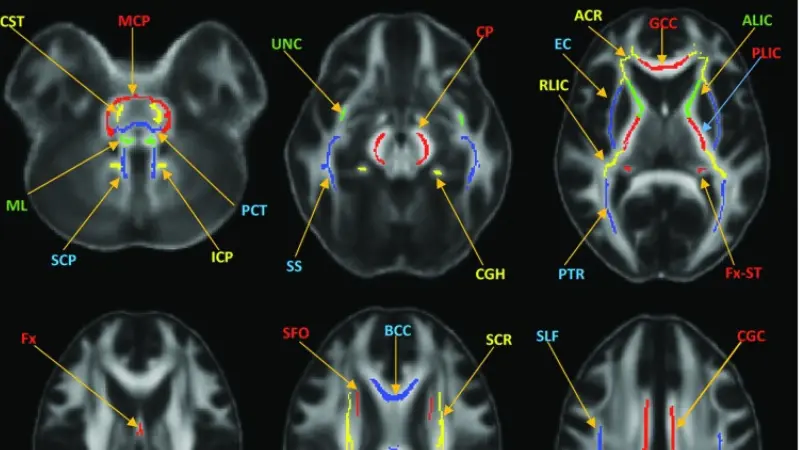 Imaginges of brain scans, TBI