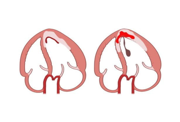 This illustration shows a heart muscle comparison of a left ventricular blood clot formation in non-hemorrhagic infarction on the left versus hemorrhagic myocardial infarction on the right. 