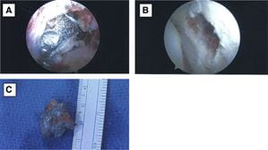 Images of bullet fragments collected by researchers at IU School of Medicine.