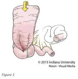 Indiana Bladder 35 years of the Indiana Pouch