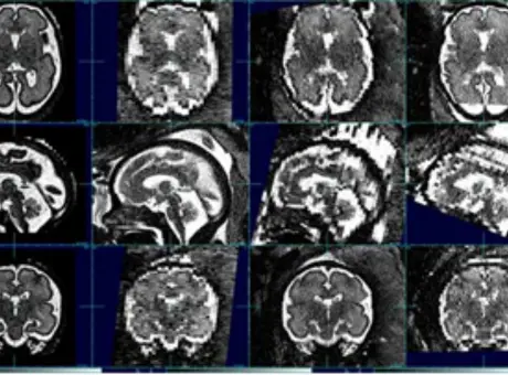 imaging of brains