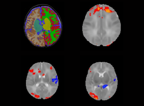 imaging of brains