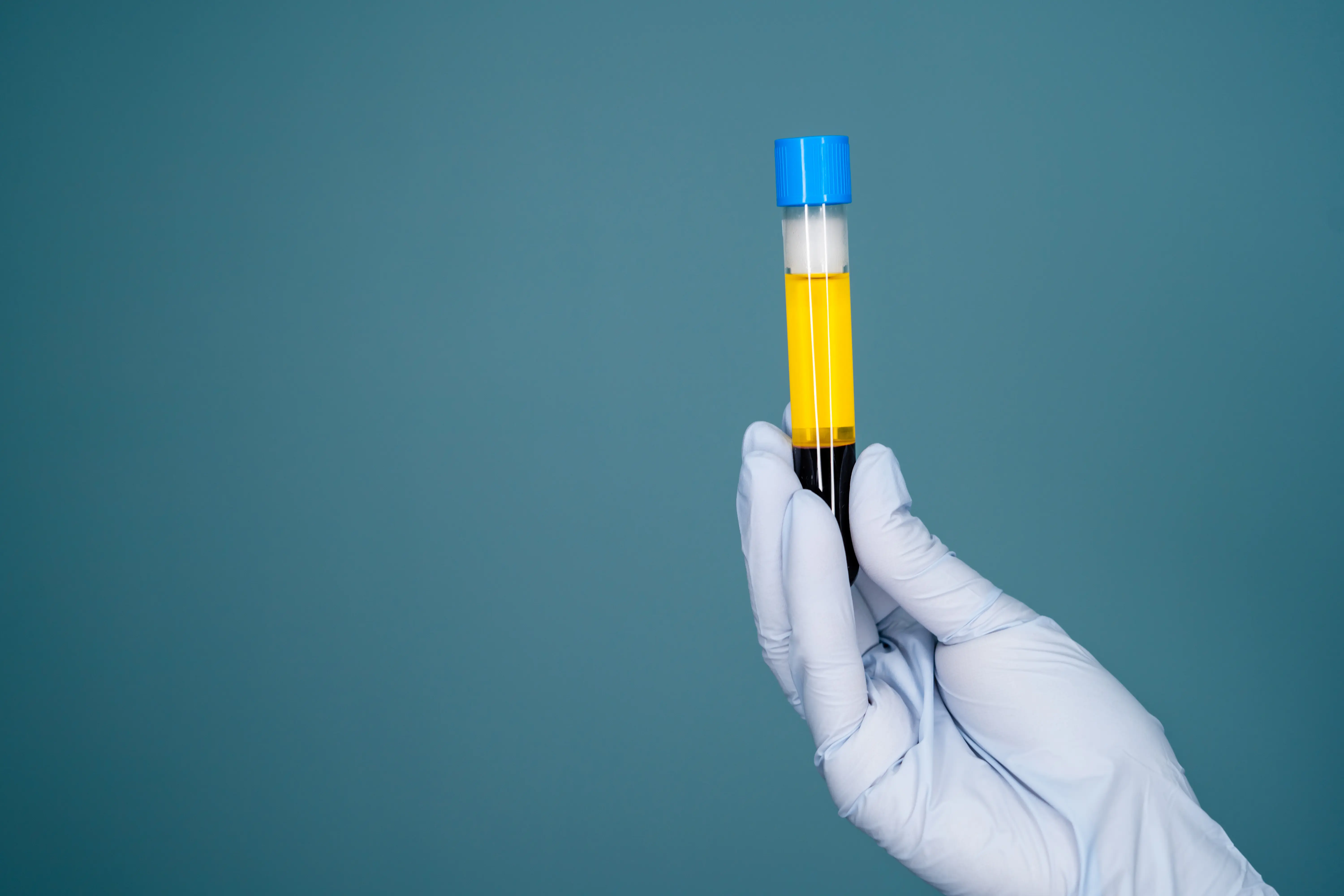 a gloved hand holds up a blood plasma sample tube