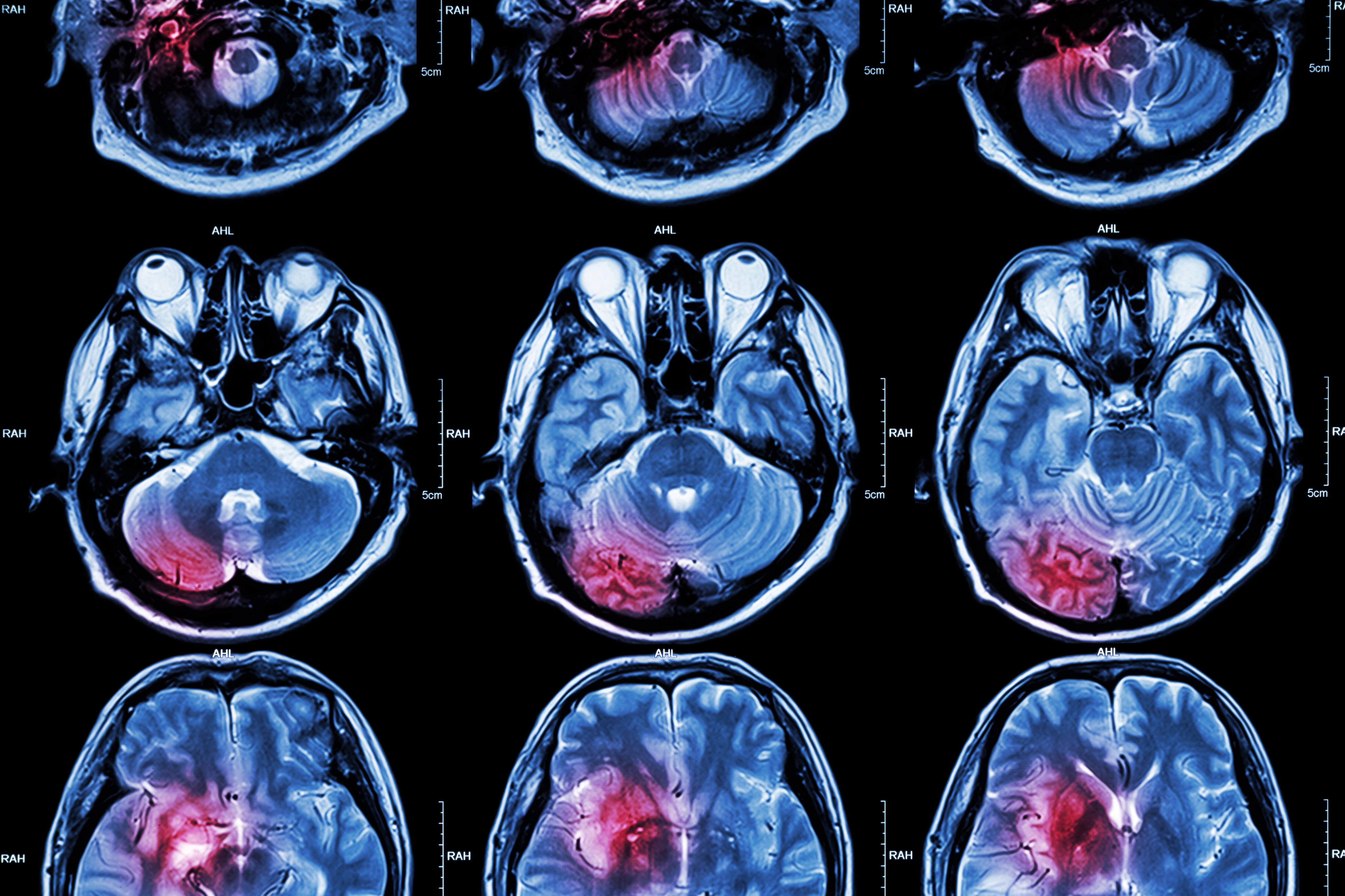 ENRICH trial brain scan image