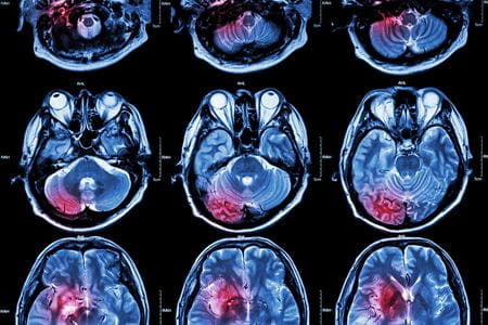 ENRICH trial brain scan image