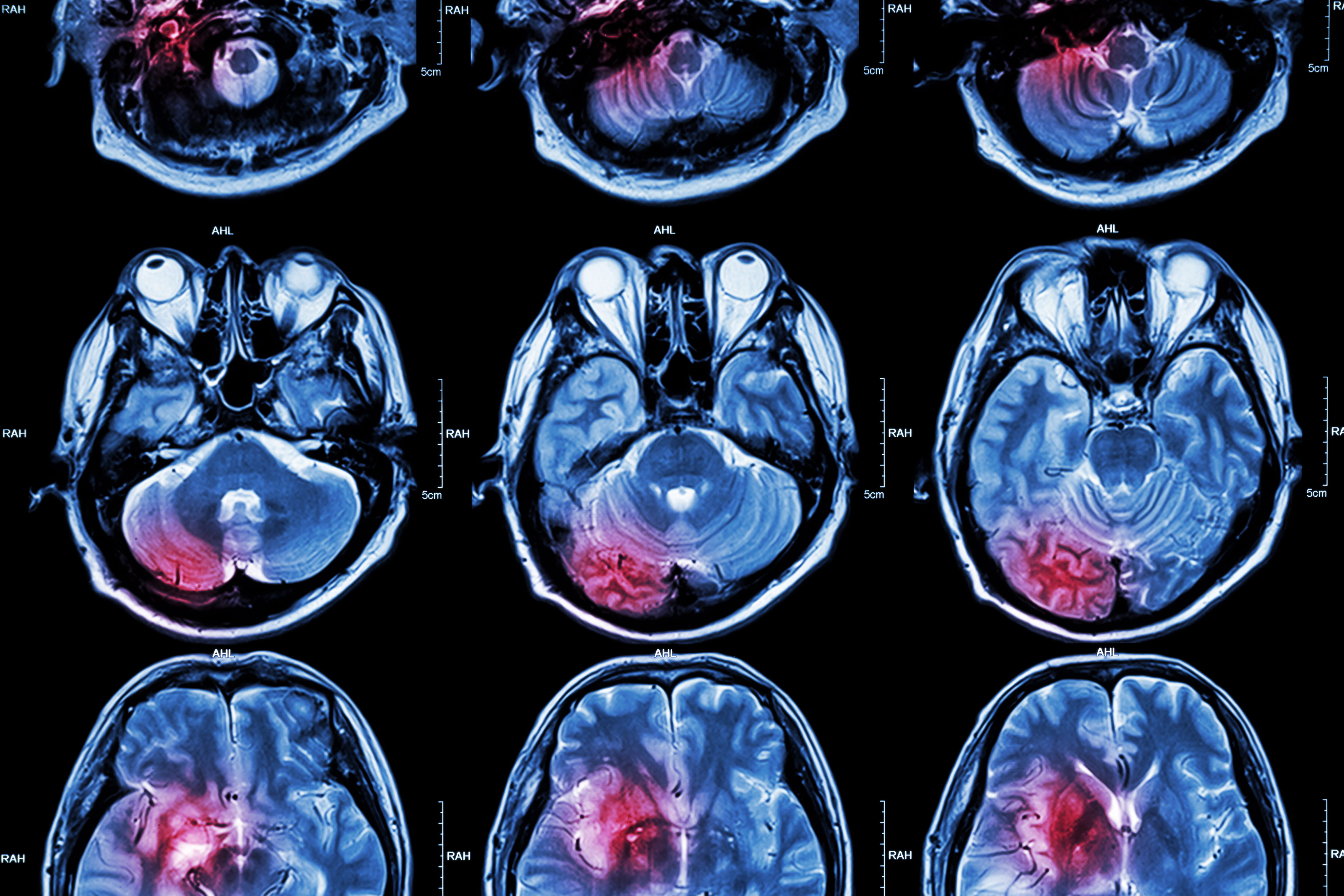 ENRICH trial brain scan image