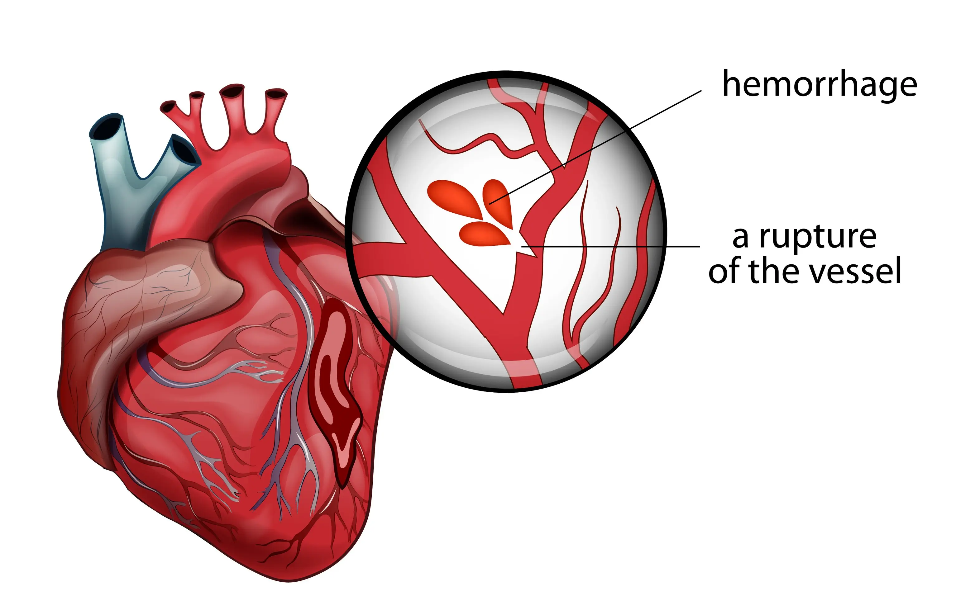 his illustration shows the anatomy of the heart and a rupture in the blood vessel that causes bleeding. 