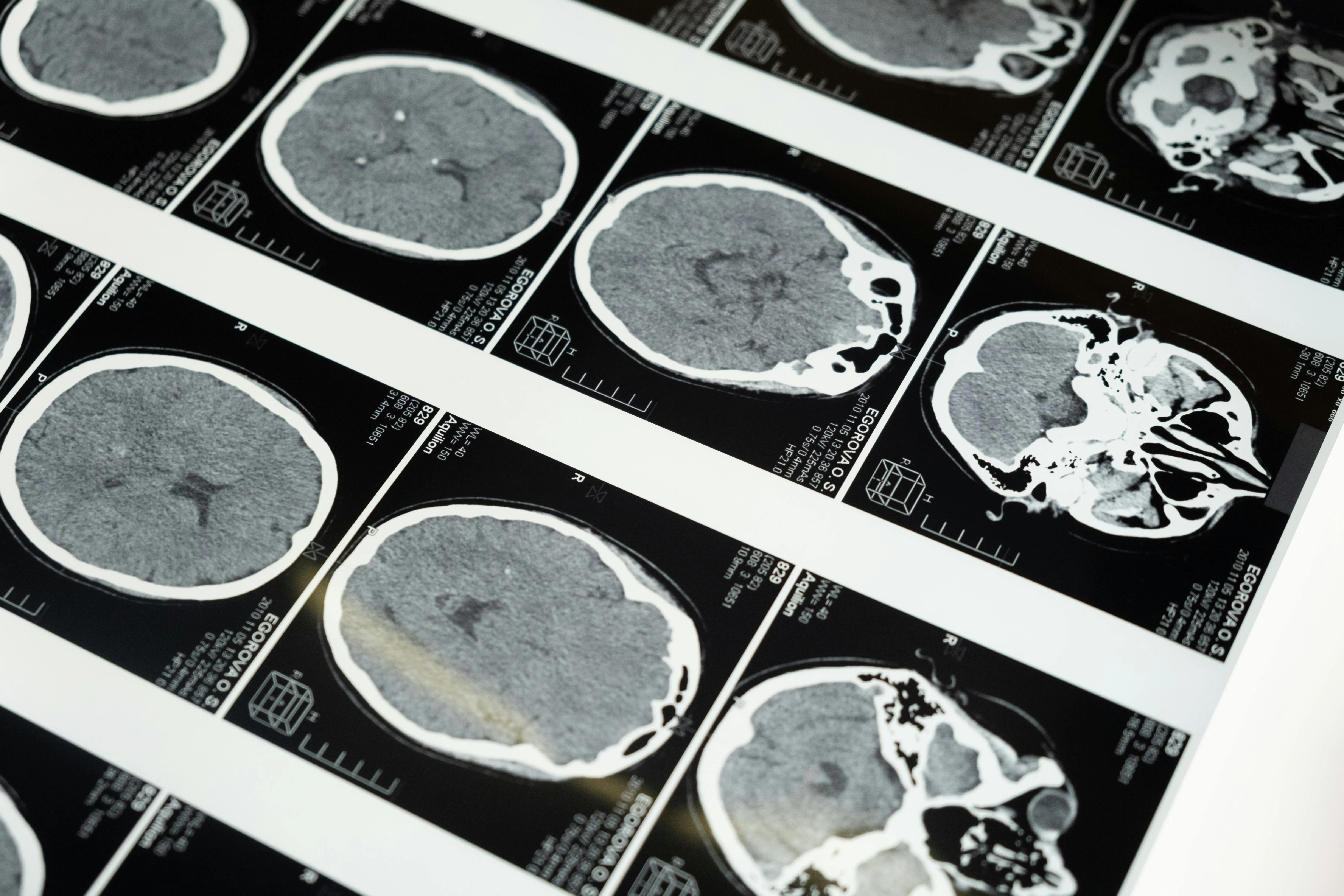 Image of neuro scans.