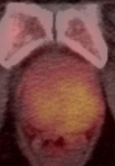 imaging of a prostate