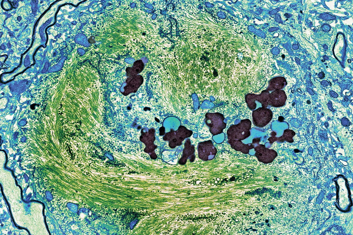 microscopic sample of brain tissue in light blue, green and black colors with swirling pattern
