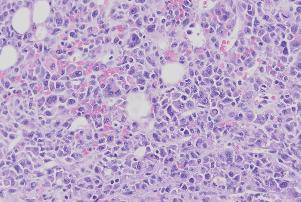 microscopy image of myeloma in plasma cells
