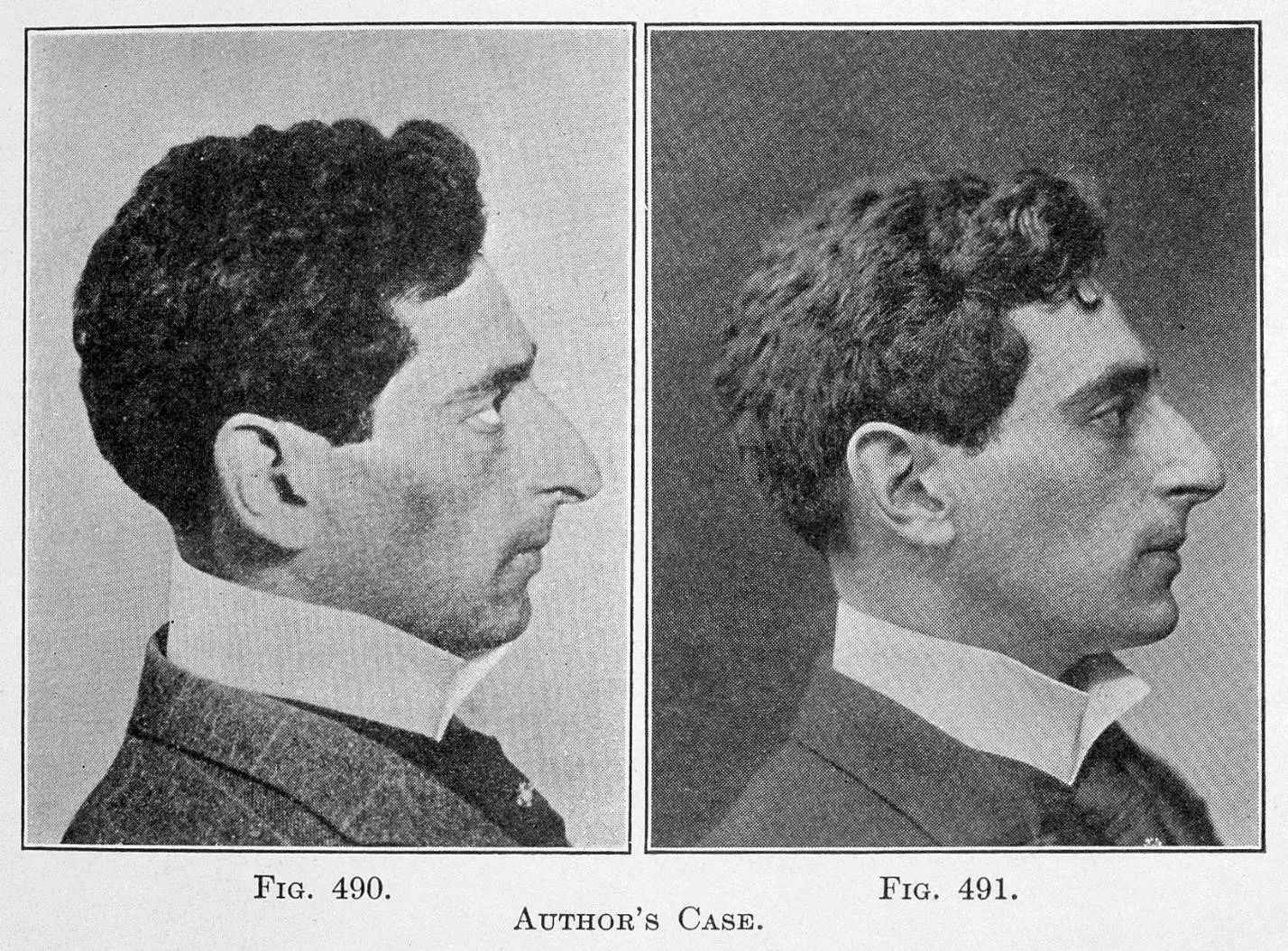 An illustration from the History of Medicine Book of the Week: Plastic and Cosmetic Surgery (1911)