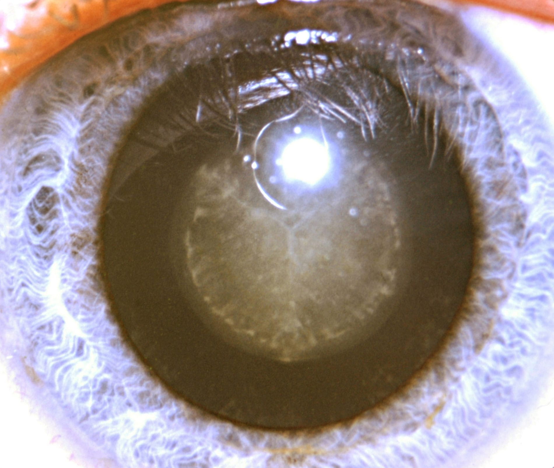 Cataract-image-IU-2