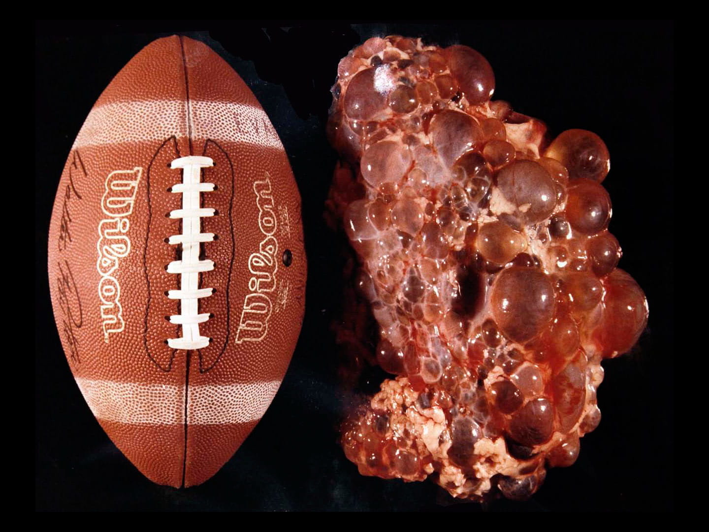 Football-PKD-200905271