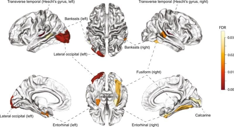 Regions showing significant changes of gray matter volume in UK Biobank (UKB) subjects with high cis-regulated PSI (Ψ̂ Ψ^) compared with individuals having low Ψ̂ Ψ^. FDR of the changes were mapped to the Desikan–Killiany atlas regions. brain illustration
