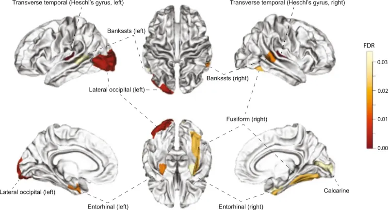Regions showing significant changes of gray matter volume in UK Biobank (UKB) subjects with high cis-regulated PSI (Ψ̂ Ψ^) compared with individuals having low Ψ̂ Ψ^. FDR of the changes were mapped to the Desikan–Killiany atlas regions. brain illustration