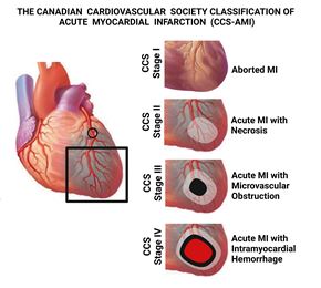illustration of a heart shows highlighted area of myocardial infarction. Four stages are shown: aborted MI, acute MI with necrosis, acute MI with microvascular obstruction, and acute MI with intramyocardial hemorrhage