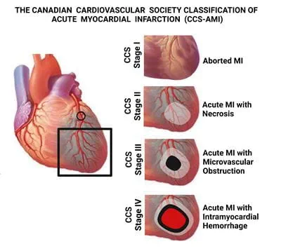 This illustration outlines four stages the Canadian Cardiovascular Society has endorsed for its new CCS Classification of Acute Myocardial Infarction (CCS-AMI), which is the world’s first clinical classification for a heart attack based on heart tissue damage. This illustration outlines four stages the Canadian Cardiovascular Society has endorsed for its new CCS Classification of Acute Myocardial Infarction (CCS-AMI), which is the world’s first clinical classification for a heart attack based on heart tissue damage.