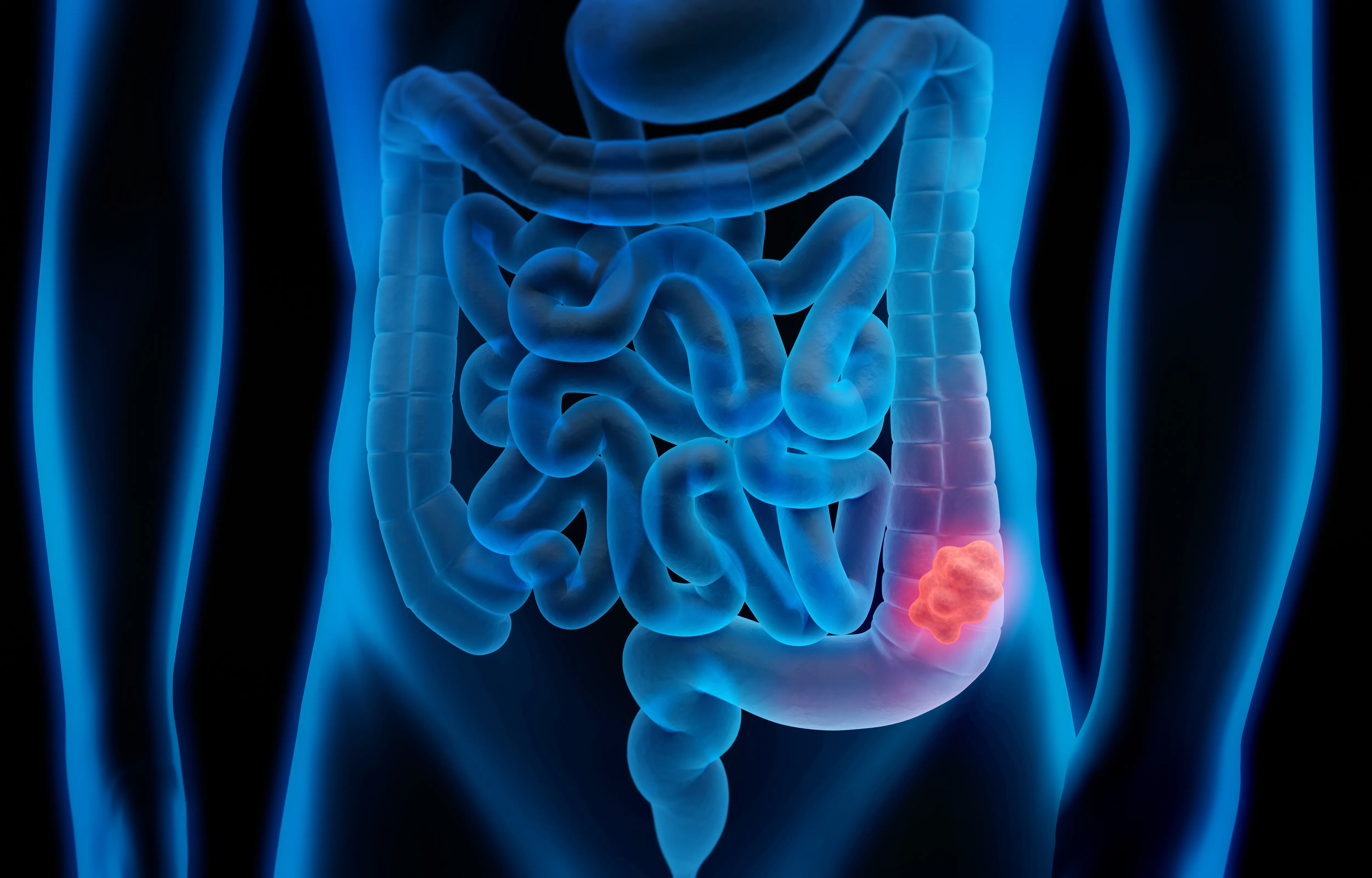 An illustration of a blockage in a digestive tract. 